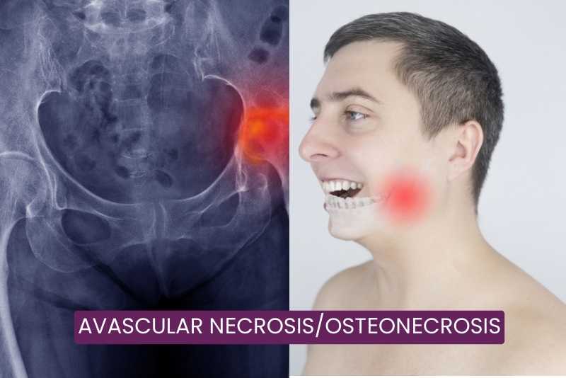 Avascular Nеcrosis/Ostеonеcrosis Trеatmеnt