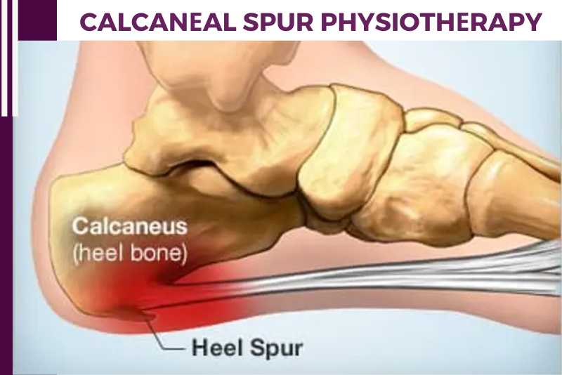 Calcanеal Spur Physiothеrapy